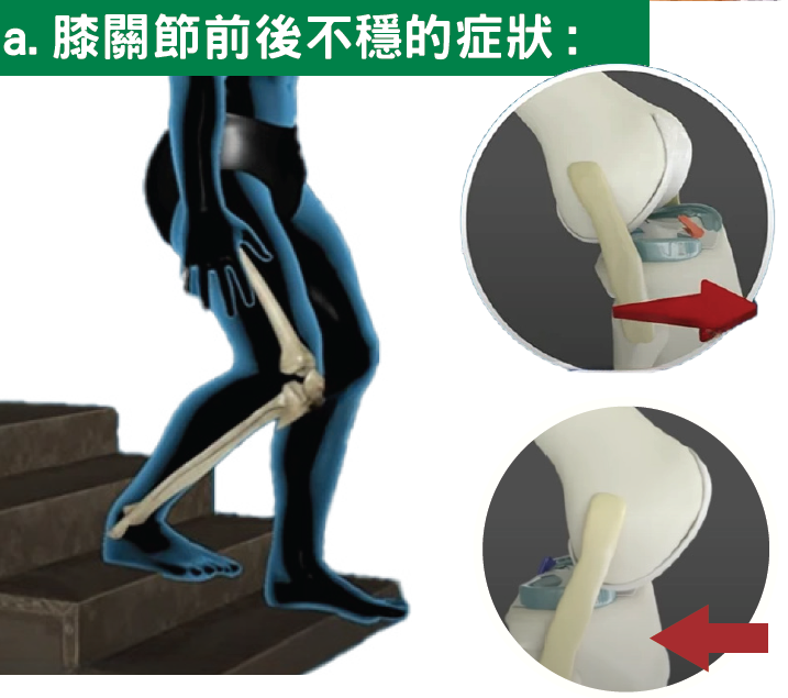 Leg on Stairs